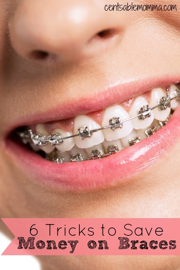 6 Tricks to Save Money on Braces Centsable Momma